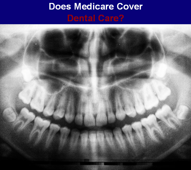 Does Medicare Cover Dental Care, Implants, and Dentures?