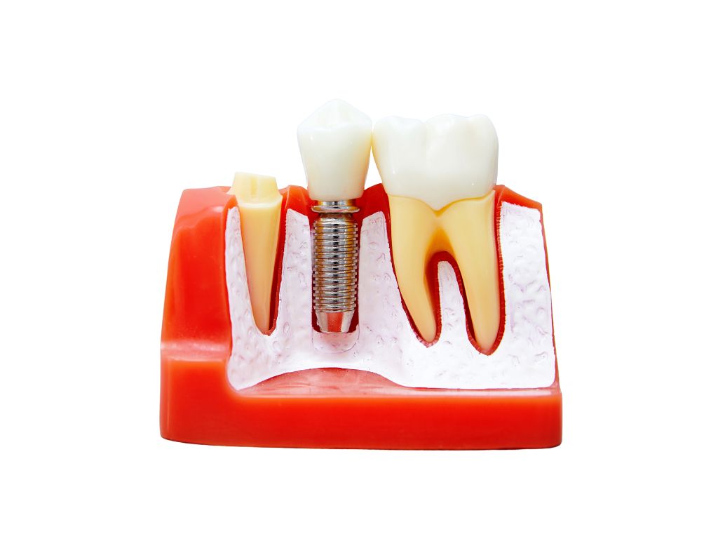 Medicare dental implant